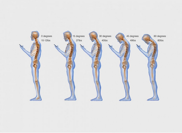 Text neck - chronic neck pain
