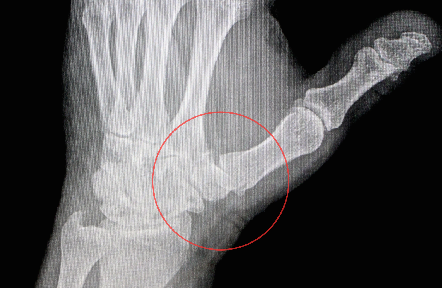 Solutions for Thumb Arthritis? We Got ’em!