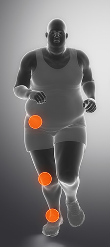 obese body prone to ankle, knee and hip pain