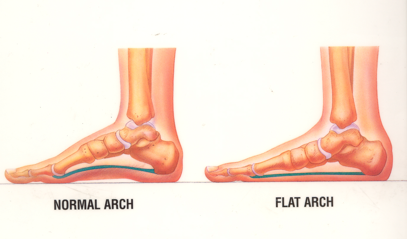 flat feet and normal feet difference