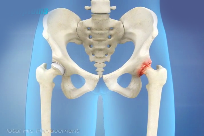 What is a Hip Replacement?